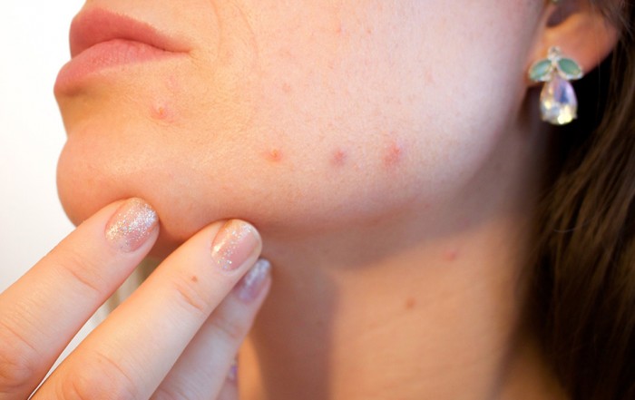 Preventing Acne